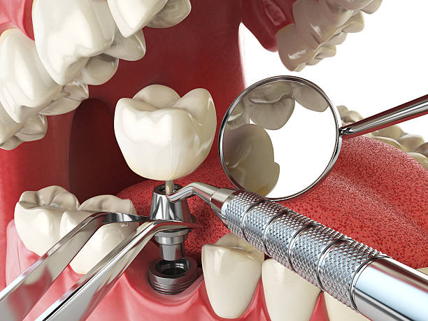 Best Emergency Tooth Extraction in Vinita, OK